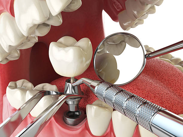 Best Broken or Chipped Tooth Repair in Lam, AR